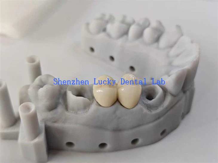 Prilagojen 3D tisk PFM Cocr Bridge Dental Lab