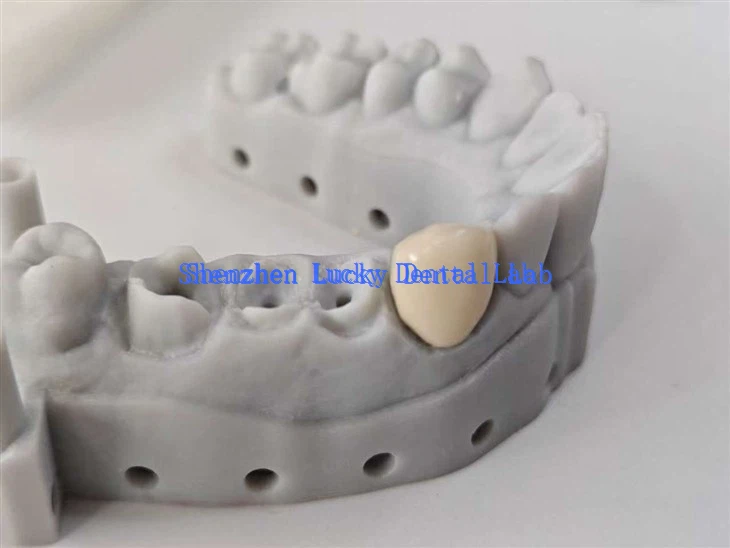 Prilagojen 3D tisk PFM COCR CROND DENTAL LAB
